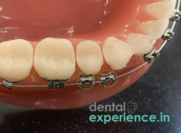 Broken orthodontic Bracket 